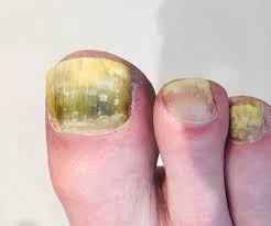 Fungal nail infection